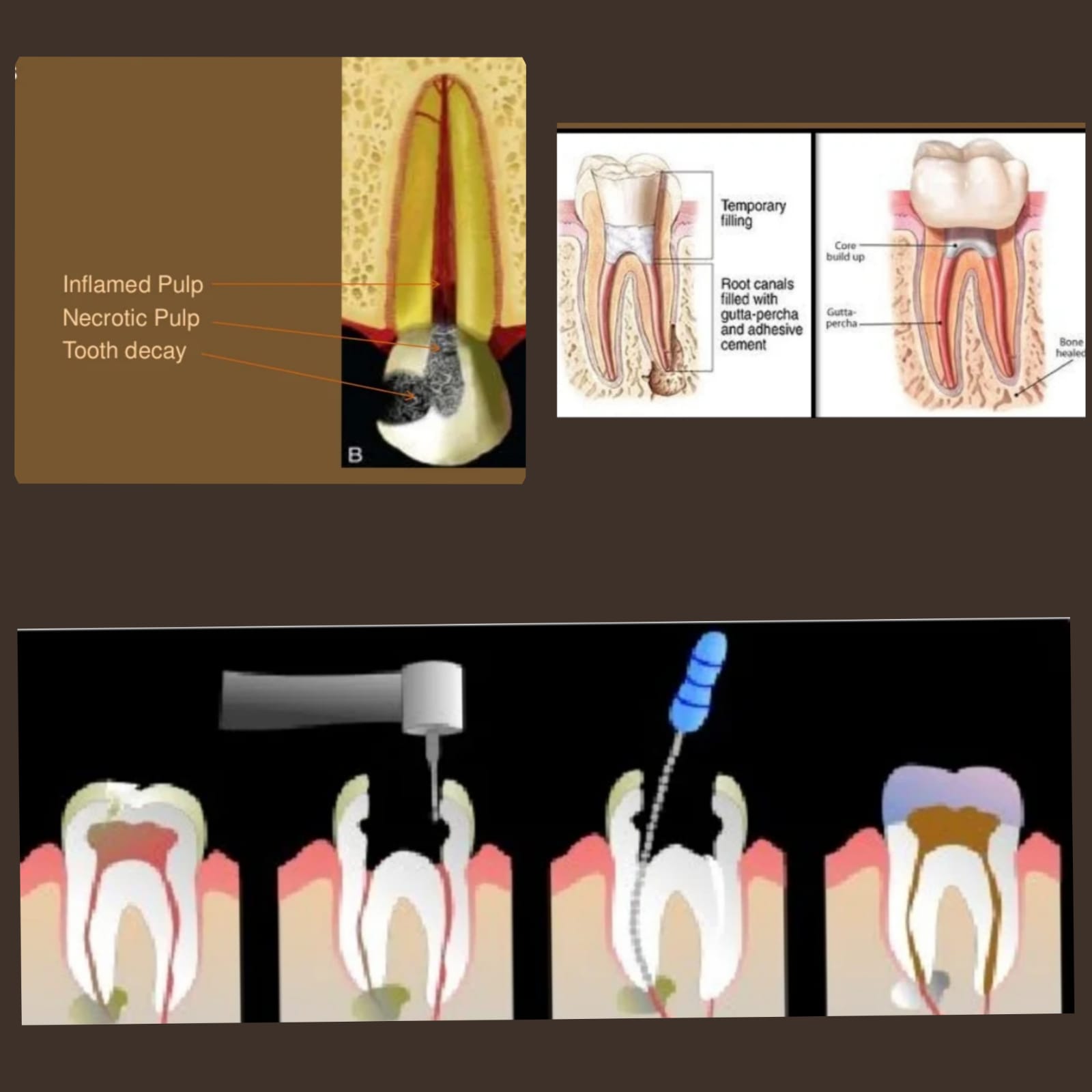 Root canal treatment or RCT in Paschim Vihar