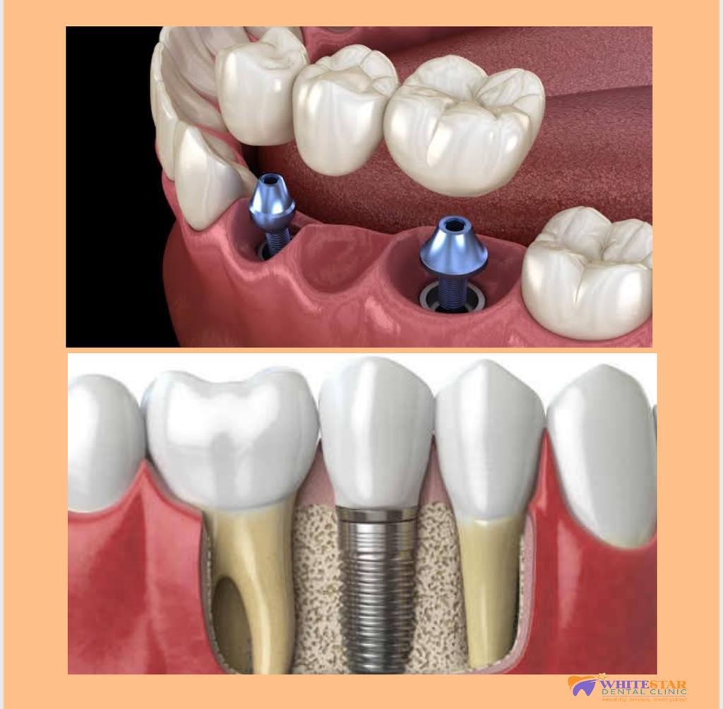 best implant dentists in Paschim Vihar