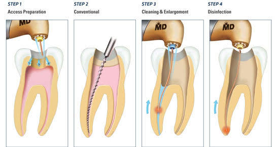 Root Canal Treatment in Paschim Vihar