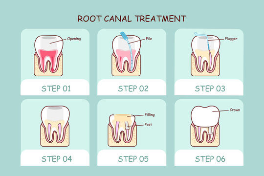 Understanding the Basics of an Root Canal Treatment