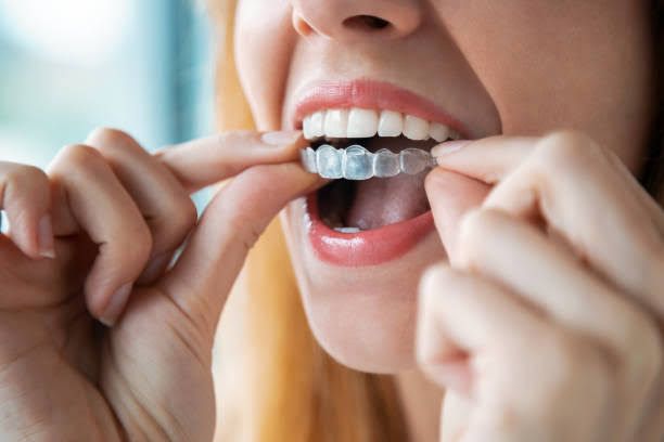 Braces Aligners Treatment in Paschim Vihar