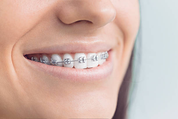 braces treatment dental in paschim vihar