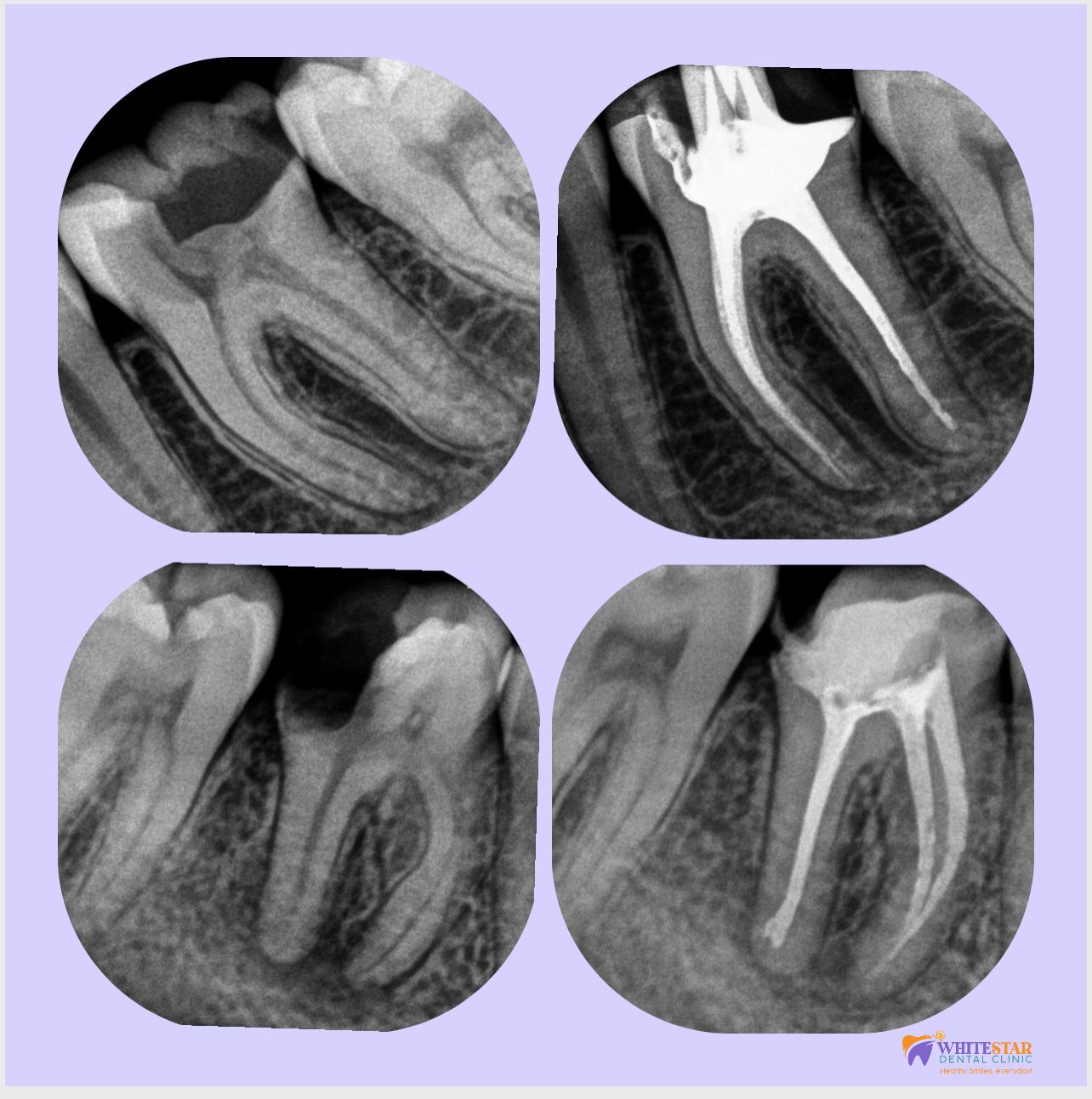 Painless Root Canal Treatment in Paschim Vihar