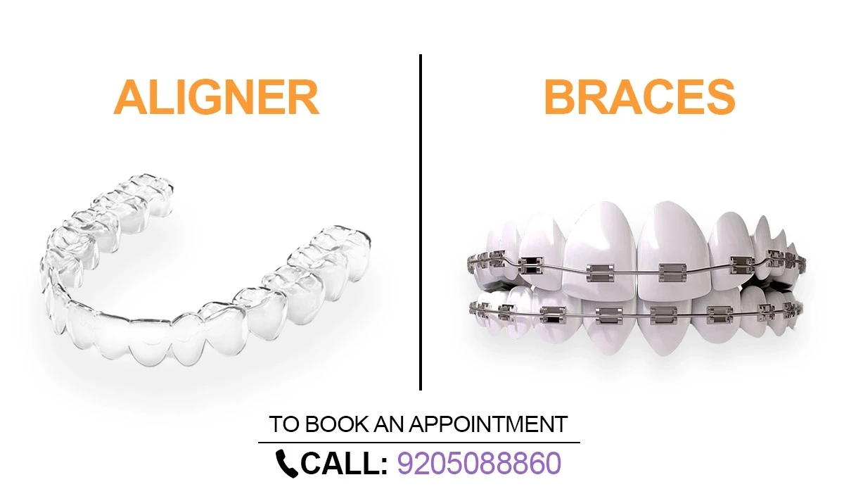 Braces Dentist Paschim Vihar