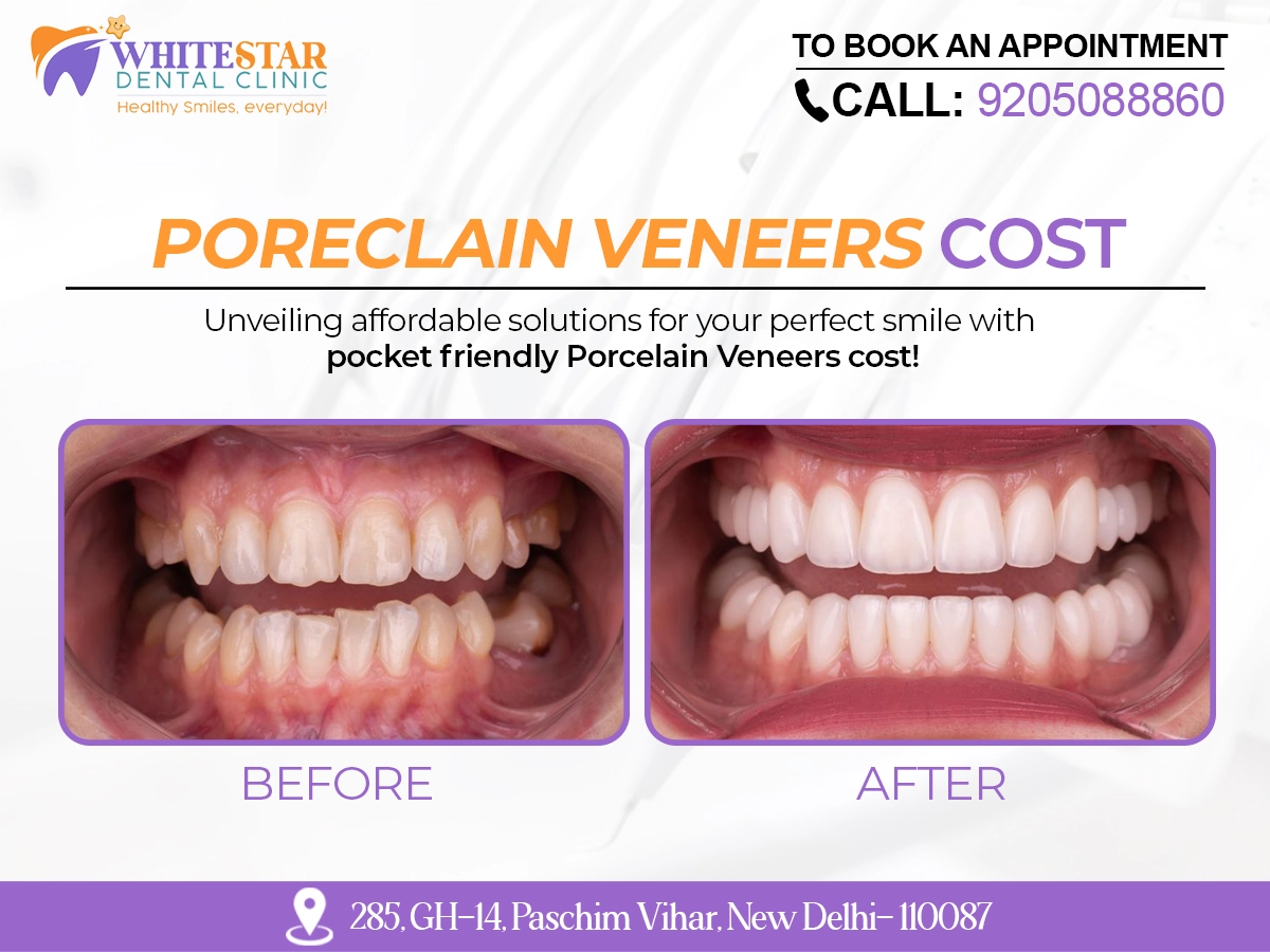 Porcelain Veneers Cost Paschim Vihar