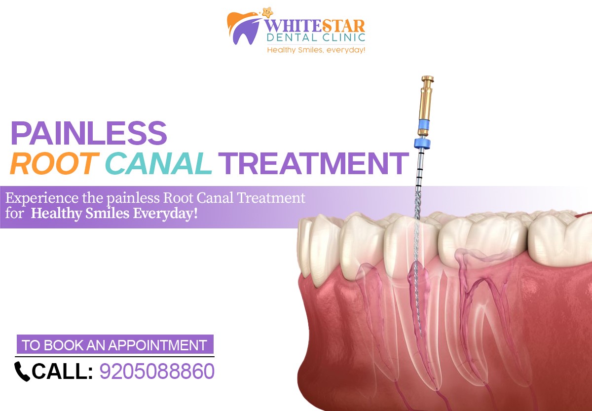 Painless Root Canal Treatment in Paschim Vihar