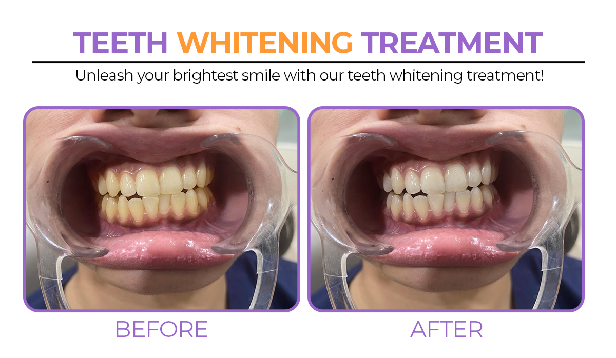 Need Teeth Whitening?